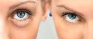 bags under eyes