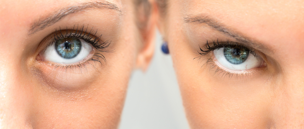 10 Best Ways To Get Rid of Bags Under Eyes