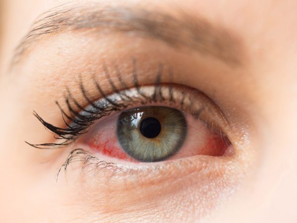 Do Eye Vitamins Help Age-related Eye Disease?